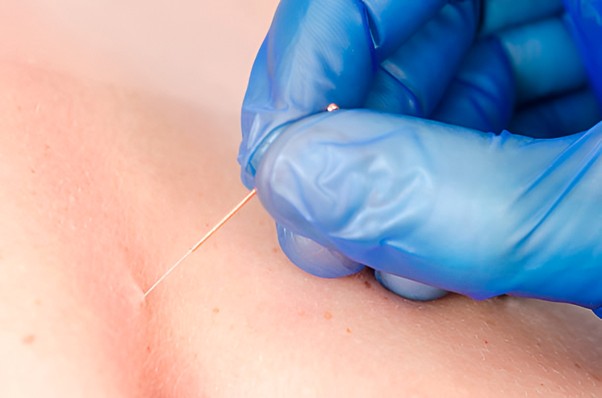 7 Powerful Benefits of Dry Needling for Chronic Muscle Pain